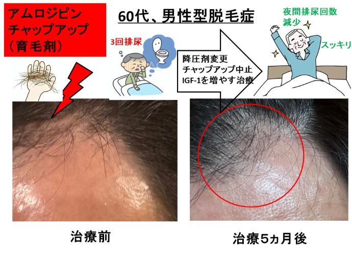 円形脱毛症　病院